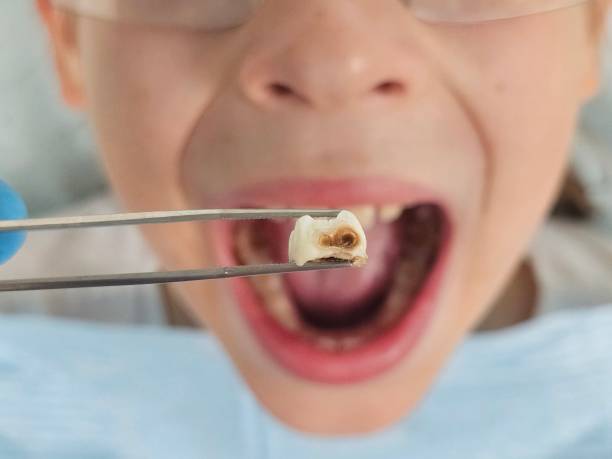 Best Emergency Treatment for Toothache in Lorena, TX