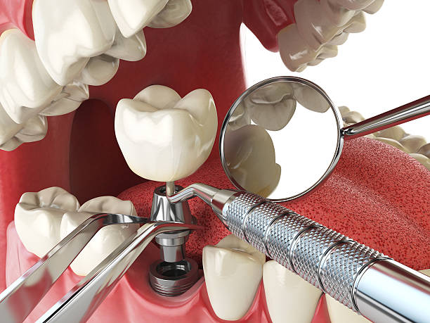 Best Emergency Root Canal Treatment in Lorena, TX